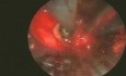 Electrosurgery And Balloon Tracheoplasty In Post-Intubation Stenosis