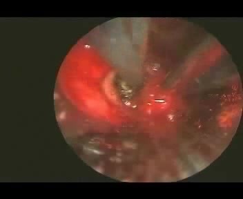 Electrosurgery And Balloon Tracheoplasty In Post-Intubation Stenosis