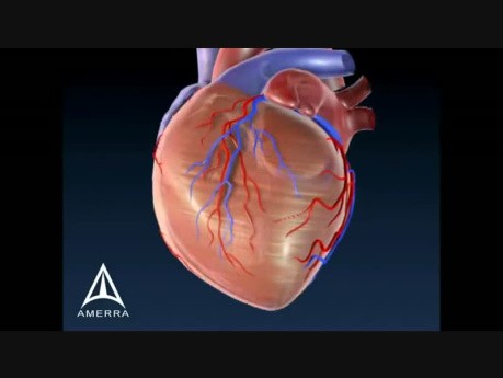 Coronary Plaque - 3D Medical Animation
