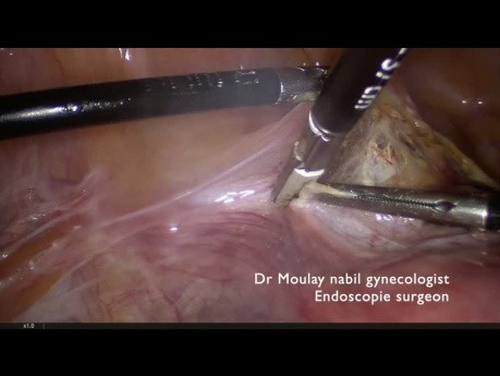 Hysterectomy for Residents