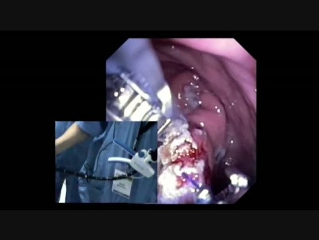 RYGB Endoscopic Endolumenal Revision with Endoscopic Suturing