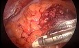 Laparoscopic abdominoperineal resection