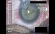 Cataract Surgery IX - Part 2