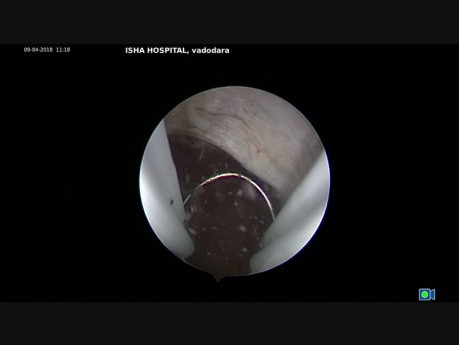 Hysteroscopic Correction of Large Isthmocele