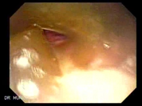 Esophageal Stent - Withdrawing The Gastroscope