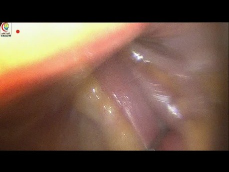 Huge Right Oblique Inguinal Hernia