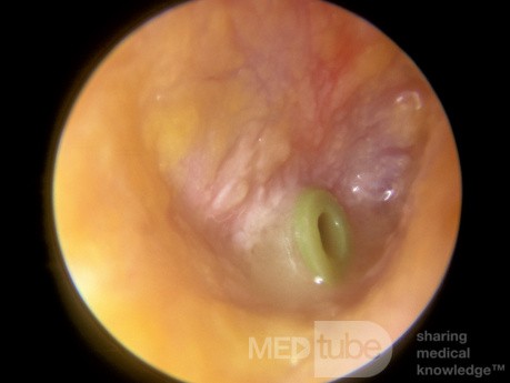 Acute Otitis Media with a Ventilation Tube in Place