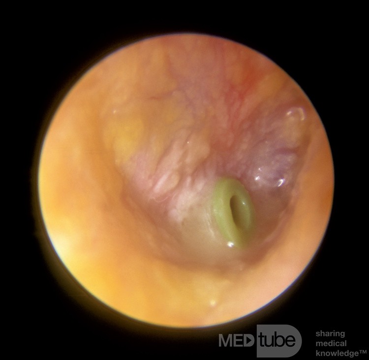 Acute Otitis Media with a Ventilation Tube in Place