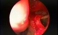 Maxillary Sinus Antrostomy - Intranasal, Endoscopic