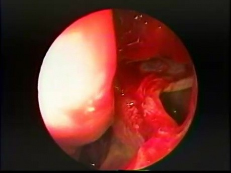 Maxillary Sinus Antrostomy - Intranasal, Endoscopic