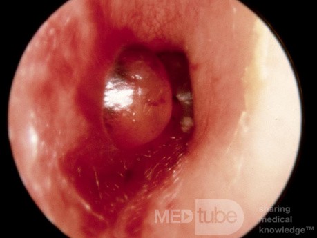 Bullous Myringitis Case 2