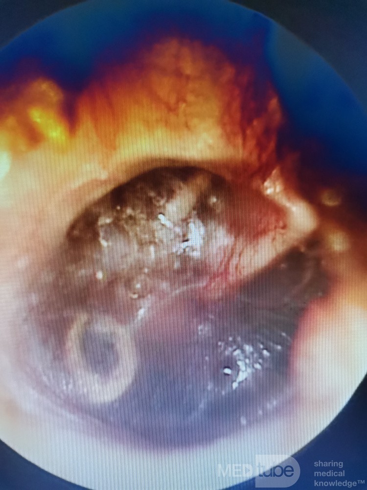 Acute Otitis Media - Endoscopy