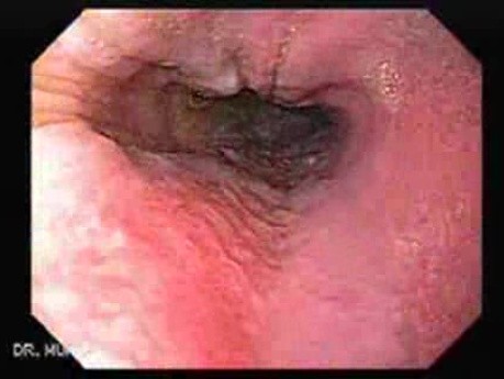 Esophagel Varices and Status Post Total Gastrectomy - Presence of Esophageal Varices