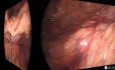 Laparoscopic Sigmoidectomy with Fluorescence - Advanced Colorectal Cancer Case (T3N2)