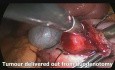 Laparoscopic Trans Duodenal Resection of Duodenal NeuroEndocrine Tumour