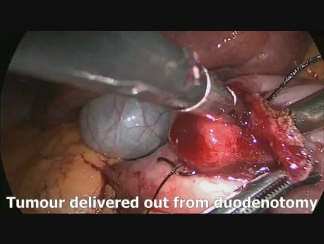 Laparoscopic Trans Duodenal Resection of Duodenal NeuroEndocrine Tumour