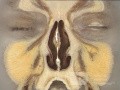 Coronal Anatomy of the Nose and Paranasal Sinuses: Slice 3