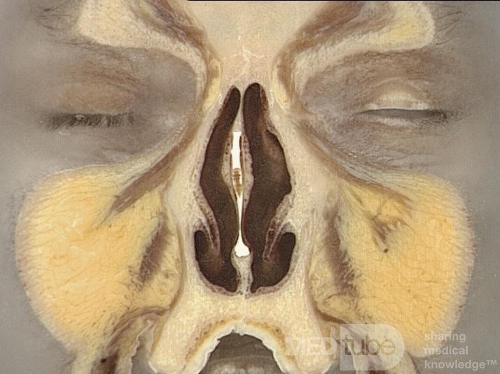 Coronal Anatomy of the Nose and Paranasal Sinuses: Slice 3
