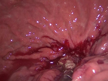 Laparoscopic Trans-Gastric Necrosectomy