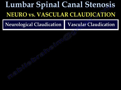 Lowback Pain - Lumbar Spinal Canal Stenosis - Video Lecture