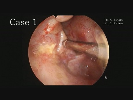 2 Cases of Mucocele