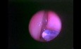 Functional Endoscopic Sinus Surgery - Anatomical Demostration - Part 1 of 5