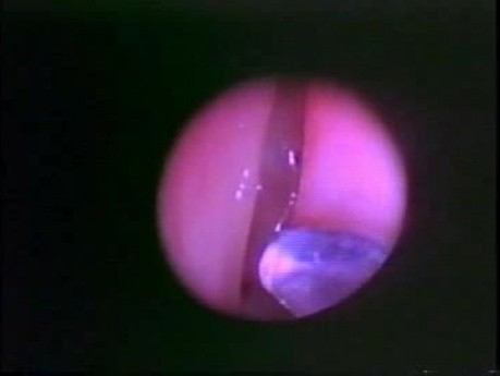 Functional Endoscopic Sinus Surgery - Anatomical Demostration - Part 1 of 5