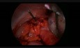 Laparoscopy For Torsion With Cyst and Second Look