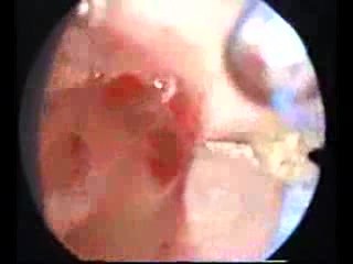 Hysteroscopic Treatment Of Septate Uterus