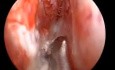 Correction of Deviated Nasal Septum by Using The Septal Stapler 