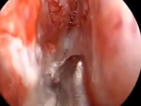Correction of Deviated Nasal Septum by Using The Septal Stapler 