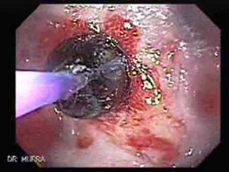 Endoscopic Baloon Dilation Of The Esophageal Stricture - Position Of The Inflated Baloon - 6/8