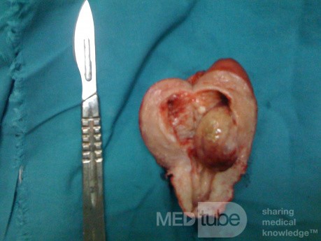Submucous Fibroid Post Menopausal
