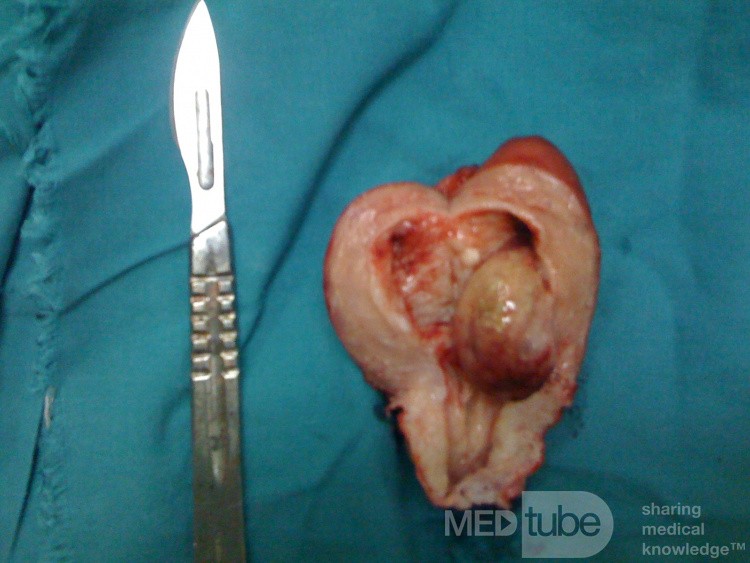 Submucous Fibroid Post Menopausal