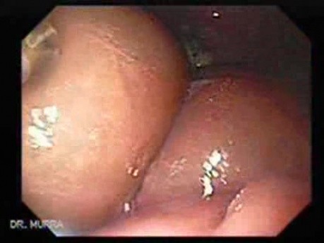 Abdominal Compartment Syndrome due to Malignancy (1 of 10)