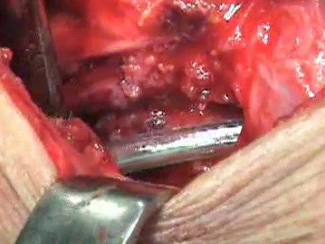Perforation of a Esophageal Carcinoma after the procedure with hydrostatic balloon dilation (9 of 12)