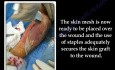 Skin Graft  - Video Lecture - Part 1