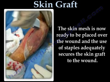 Skin Graft  - Video Lecture - Part 1