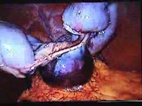 Jejunal Gastrointestinal Stromal tumor (GIST) (85 of 86)