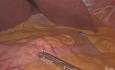 Laparoscopic D1 + Subtotal Gastrectomy