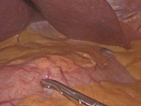 Laparoscopic D1 + Subtotal Gastrectomy
