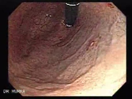 Multiple Gastric Angiodysplasia (3 of 17)