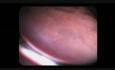 Colonoscopy Channel - Missed Polyps After Poor Bowel Preparation