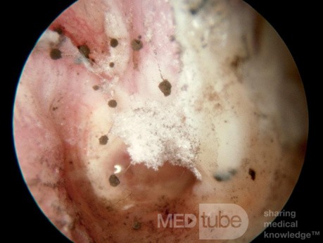 Aspergillus Niger Otomtcosis Fruiting Heads