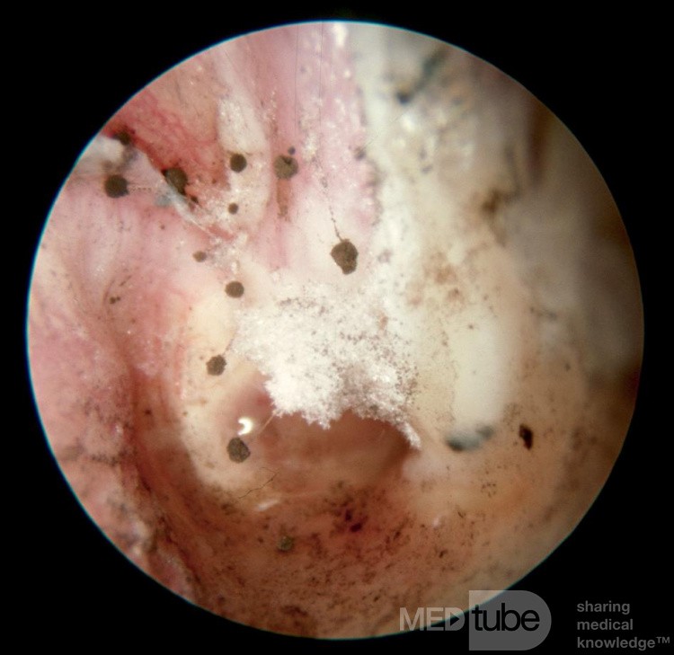 Aspergillus Niger Otomtcosis Fruiting Heads