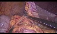 Laparoscopic Right Hemicolectomy with Intracorporeal Anastomosis