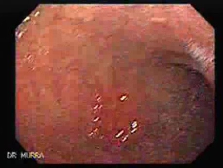 Early Gastric Adenocarcinoma - Endoscopy (3 of 5)