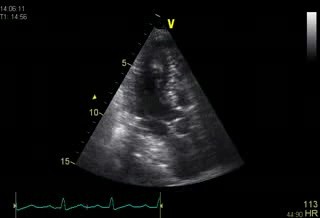 Left Atrial Compression