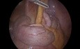 Acute Appendicitis