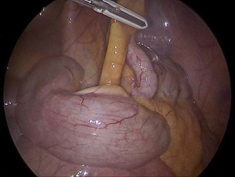 Acute Appendicitis